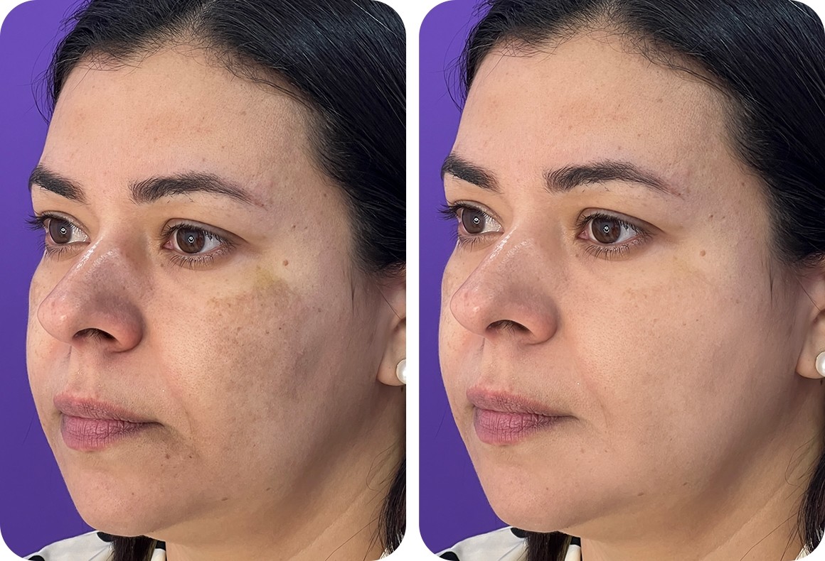 Peeling Químico vs. Peeling Físico: Qual o Melhor para Você?