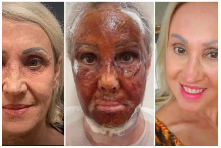 Como o Peeling Ajuda a Tratar Acne e Cicatrizes