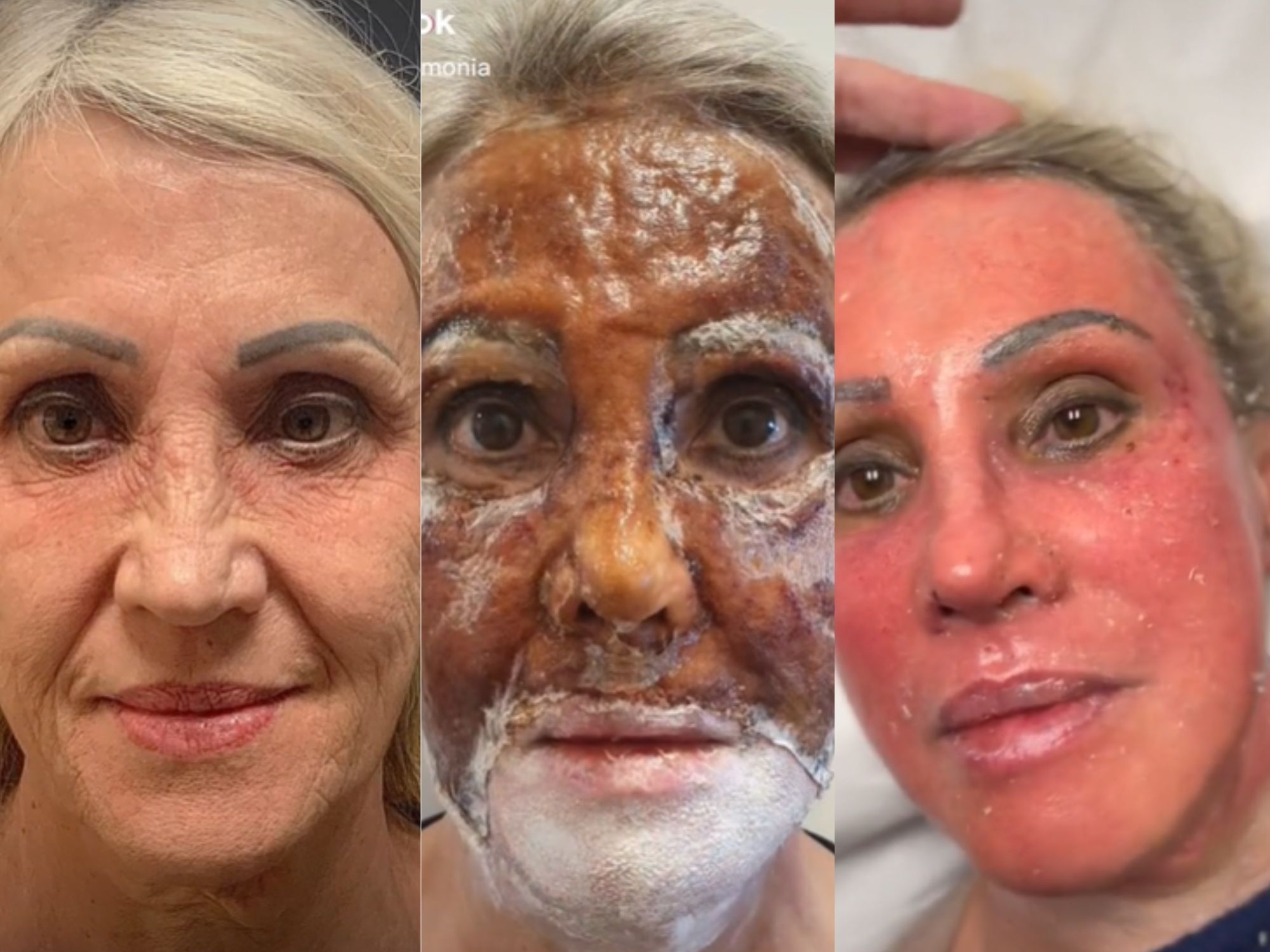 Peeling Químico vs. Peeling Físico: Qual o Melhor para Você?