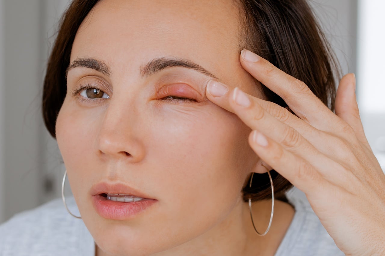cuidados com a área dos olhos inchada