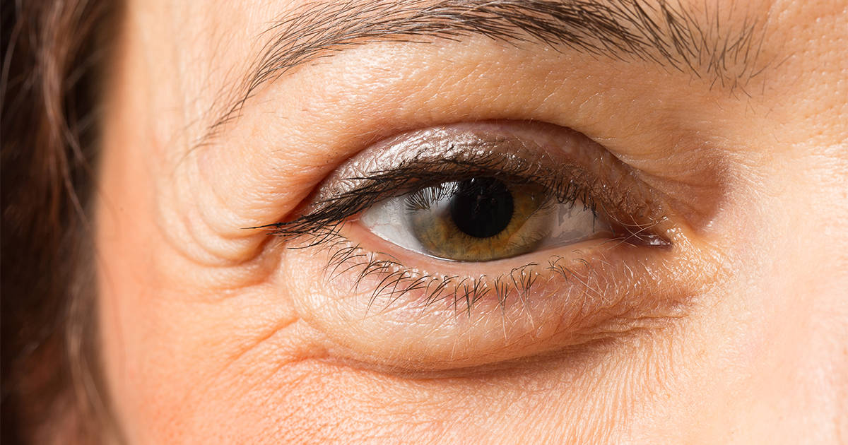 remédios caseiros para olhos inchados