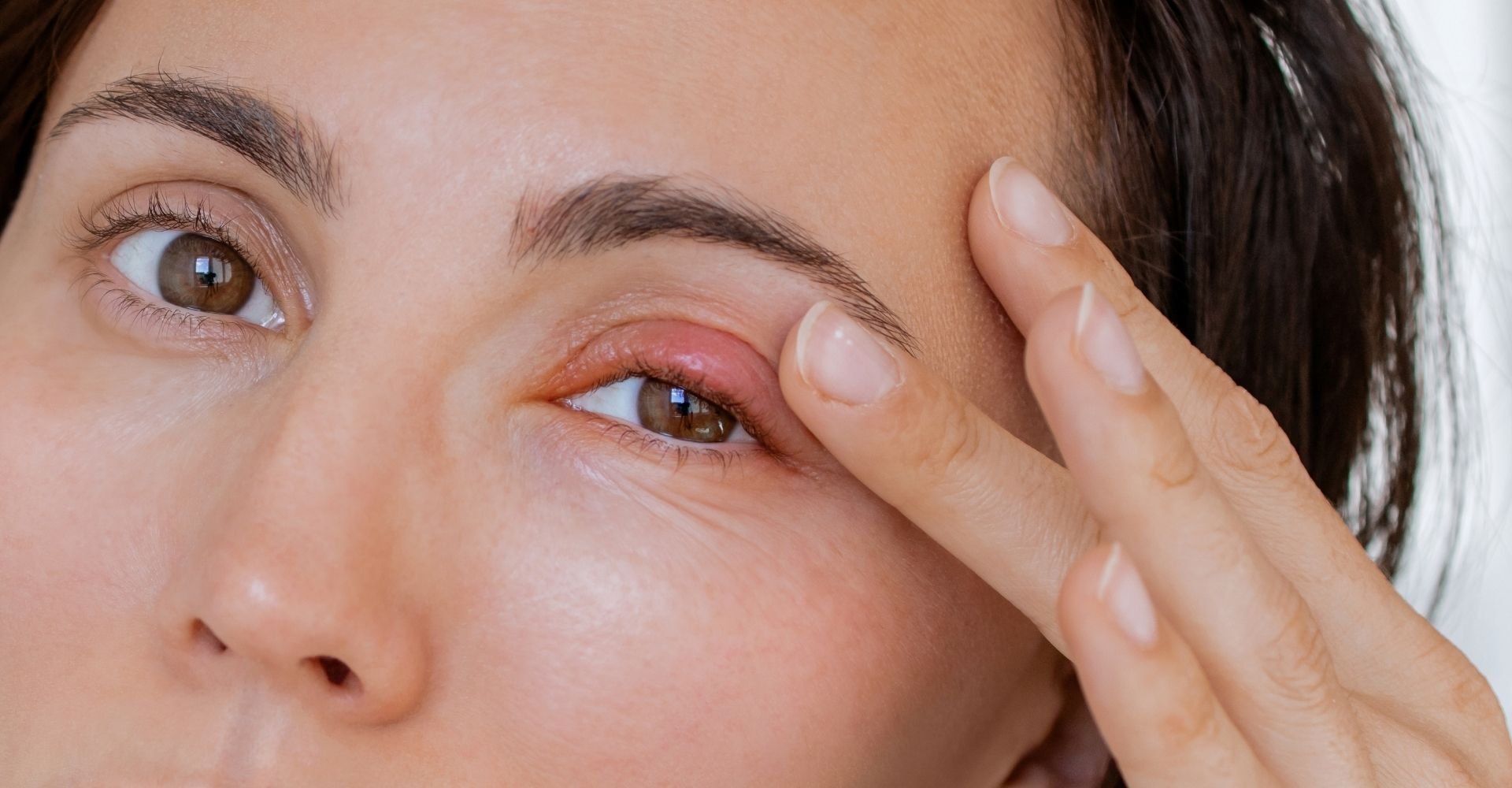 tratamento para edema palpebral