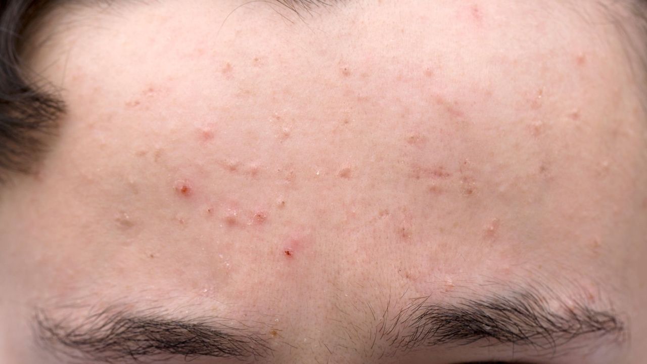 Hormônios e Acne na Zona T