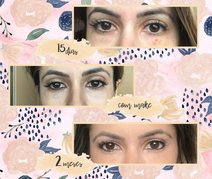 Entenda as Causas das Olheiras: De Hábitos a Condições Médicas