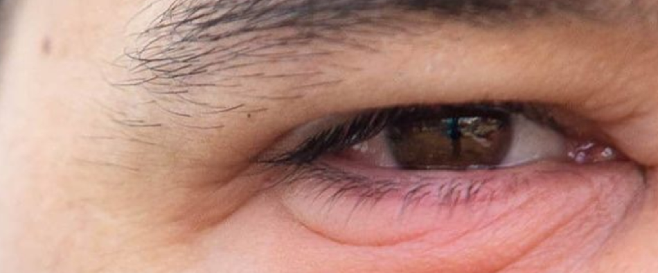 Guia Completo: Como Eliminar Olheiras e Bolsas nos Olhos