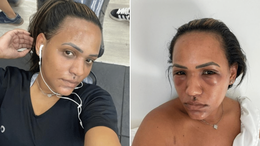 Os Melhores Cremes e Tratamentos para Olheiras: Um Guia Detalhado