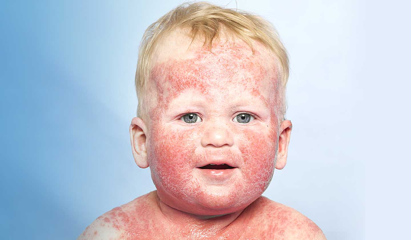 Mitos e verdades sobre a dermatite atópica: desvendando a condição