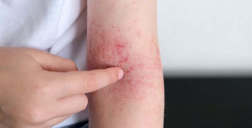 Guia completo de hidratação para pele atópica: produtos e rotinas