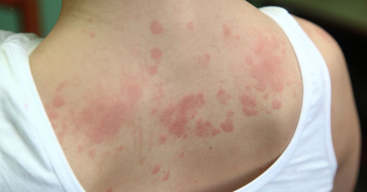 Dermatite atópica em bebês e crianças: o que os pais precisam saber