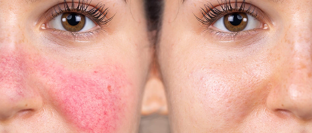 Rotina de Skincare Ideal para Peles com Rosácea