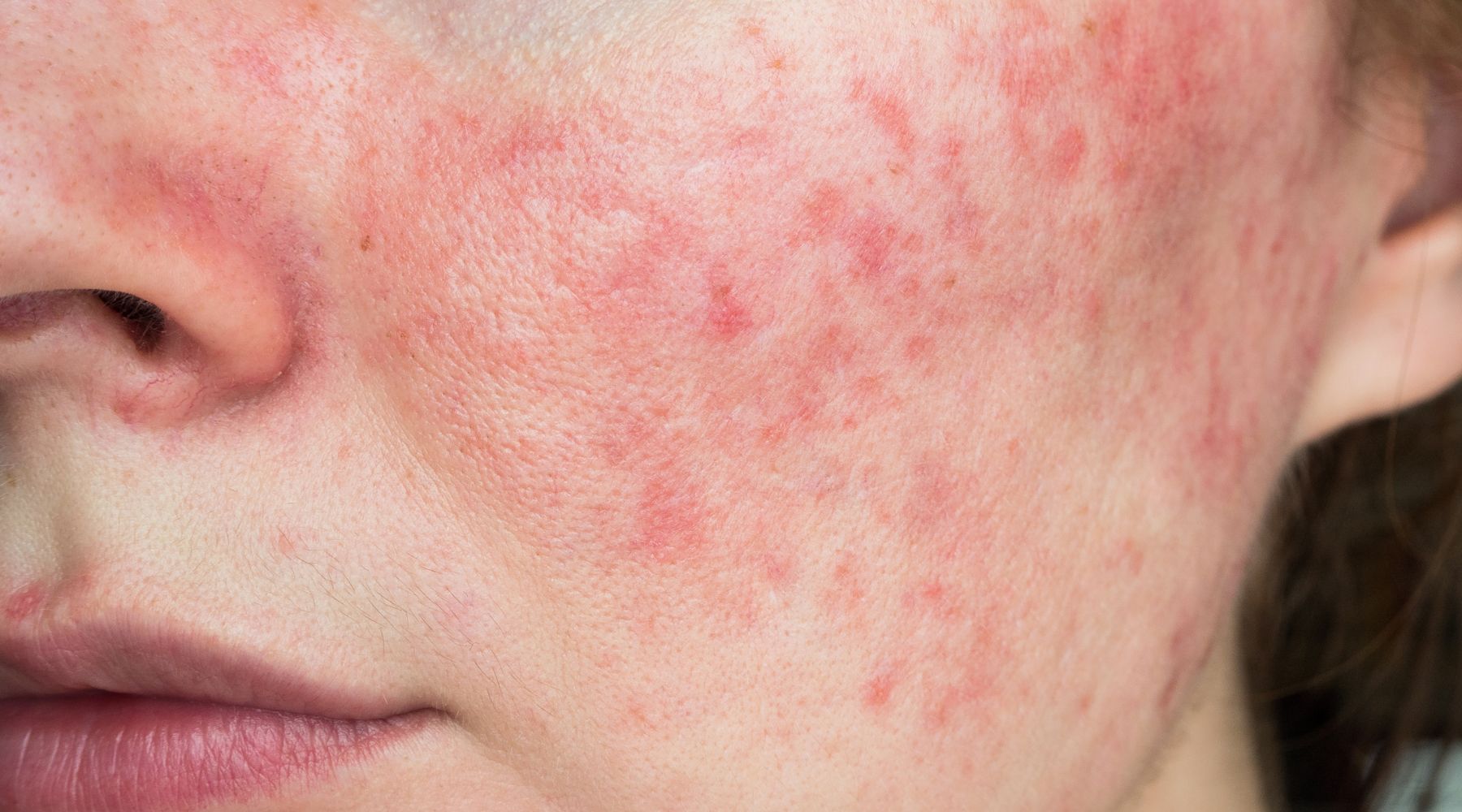 Como o Estresse Afeta a Rosácea e Dicas para Gerenciá-lo