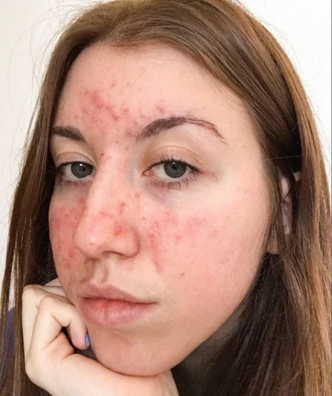 Guia Completo de Protetores Solares para Pele com Rosácea