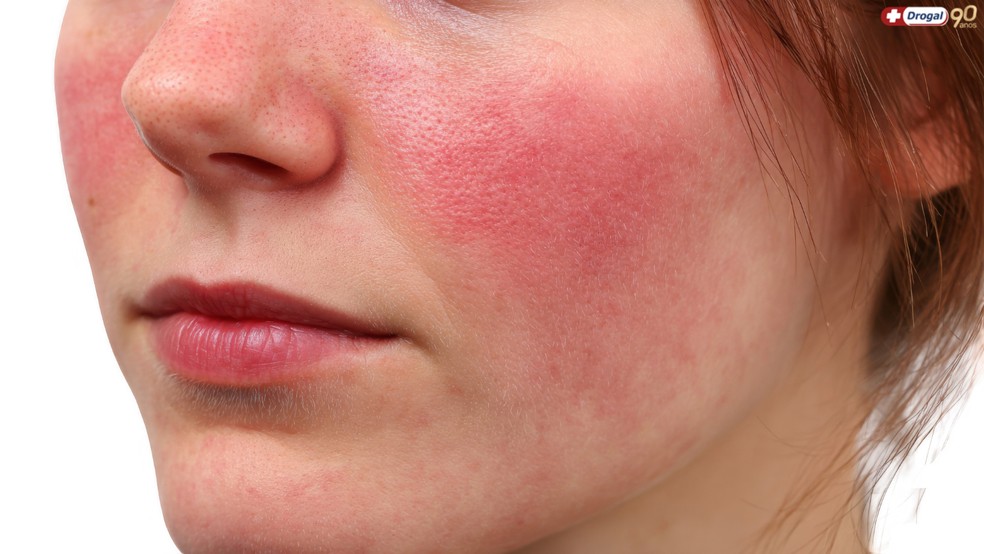 Alimentos Proibidos e Permitidos para Quem Tem Rosácea