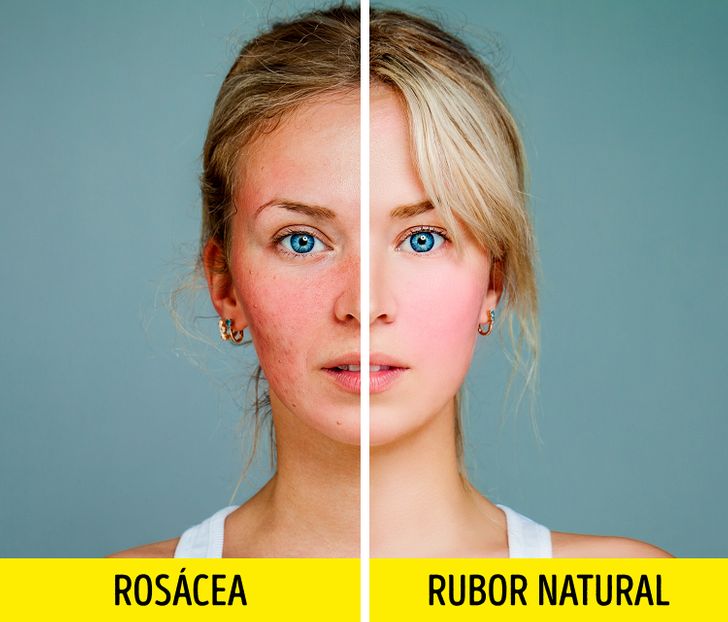 Guia Completo de Protetores Solares para Pele com Rosácea