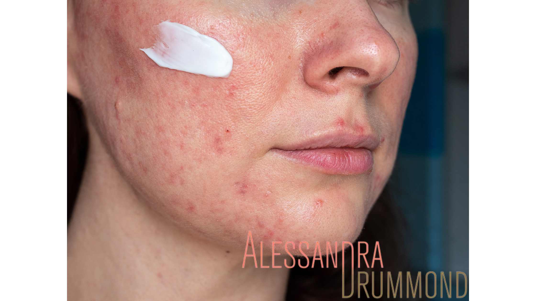 Rotina de Skincare Ideal para Peles com Rosácea