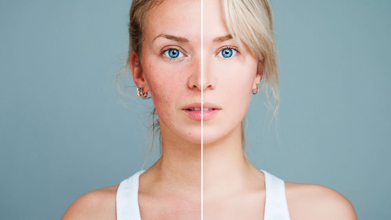 Alimentos Proibidos e Permitidos para Quem Tem Rosácea