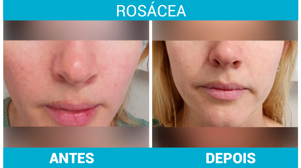 Laser e Luz Pulsada: Como Funcionam no Tratamento da Rosácea