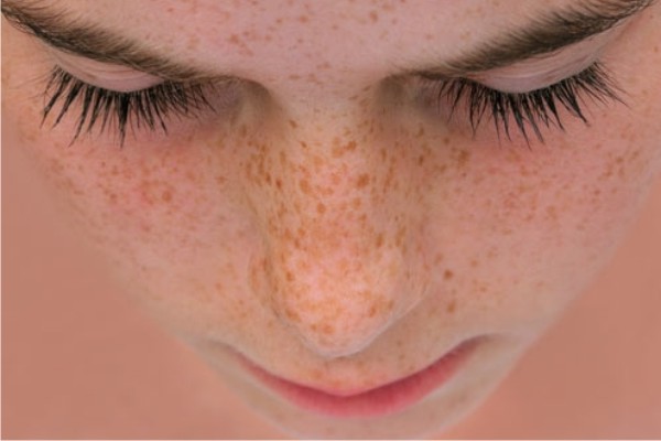 Proteção Solar Avançada: Escolhendo o Filtro Ideal para Peles com Sardas