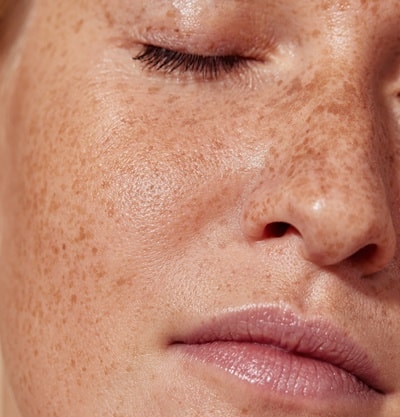 Melasma e Pintas: Saiba Diferenciar e Cuidar de Cada Mancha na Pele