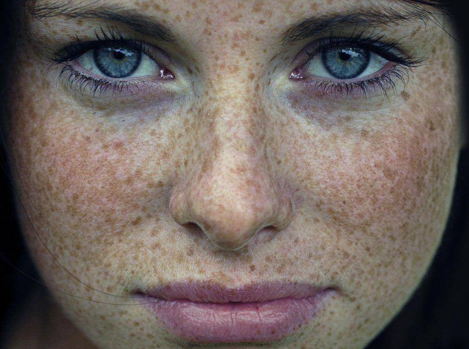 Proteção Solar Avançada: Escolhendo o Filtro Ideal para Peles com Sardas