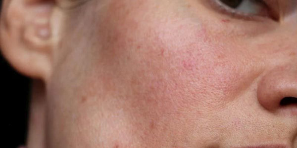 Guia Completo: Como Escolher o Melhor Hidratante para Pele Irritada