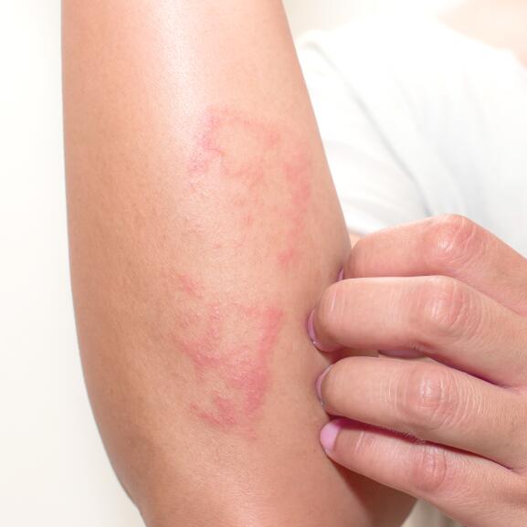 Dermatite Atópica: Sintomas