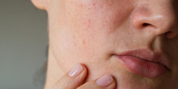 Vitamina C e Vaselina: Ingredientes Chave para a Pele Ressecada