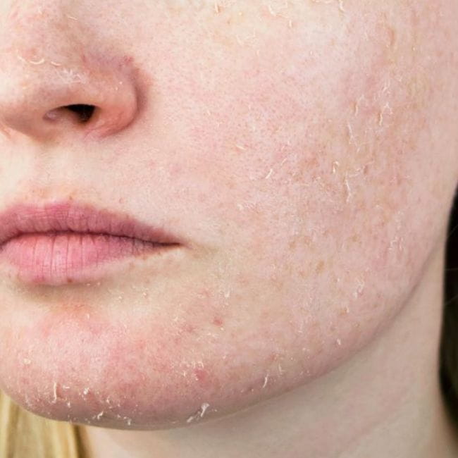 Dermatite Atópica e Pele Seca: Entenda a Relação e Cuidados Essenciais