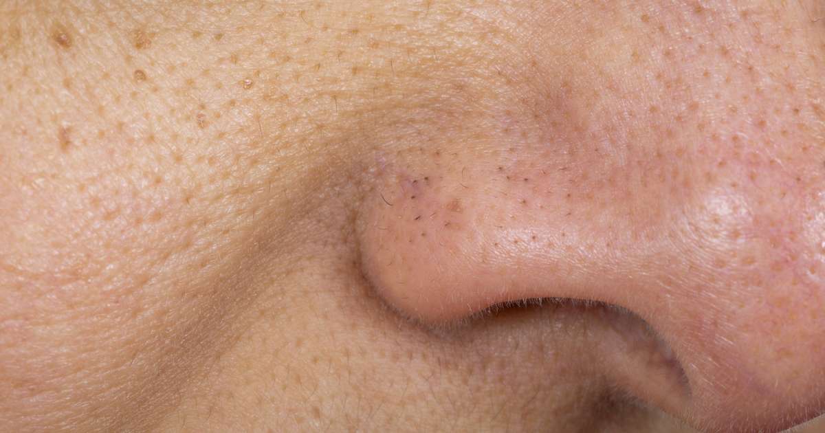 pontos pretos no nariz