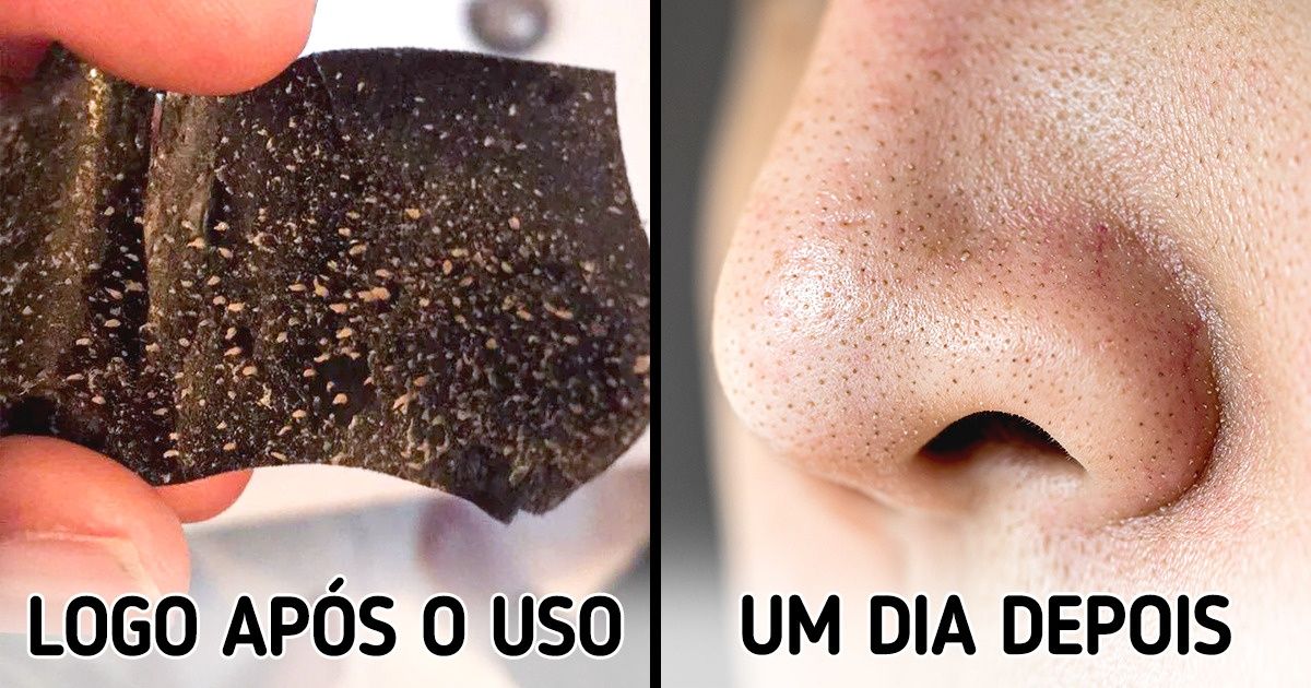 Prevenção de cravos: Hábitos essenciais para uma pele saudável