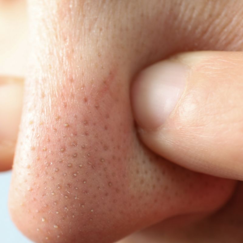 Prevenção de cravos: Hábitos essenciais para uma pele saudável