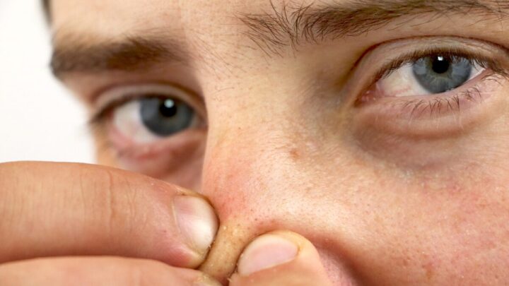 pontos pretos no nariz