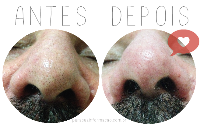 Guia completo: Cravos vs. Filamentos Sebáceos - Entenda as diferenças