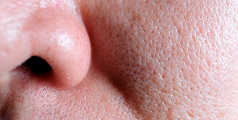 Os Melhores Ativos para Reduzir Poros Dilatados: Niacinamida