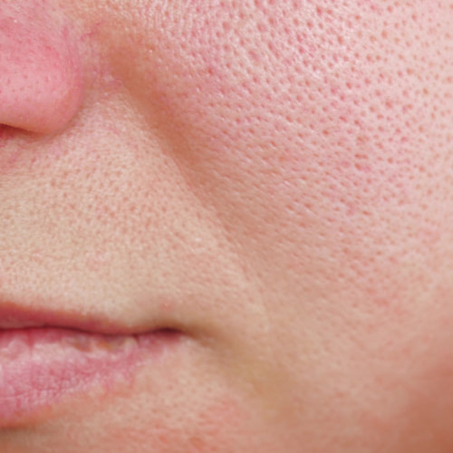 Procedimentos Estéticos para Poros Dilatados: Microagulhamento