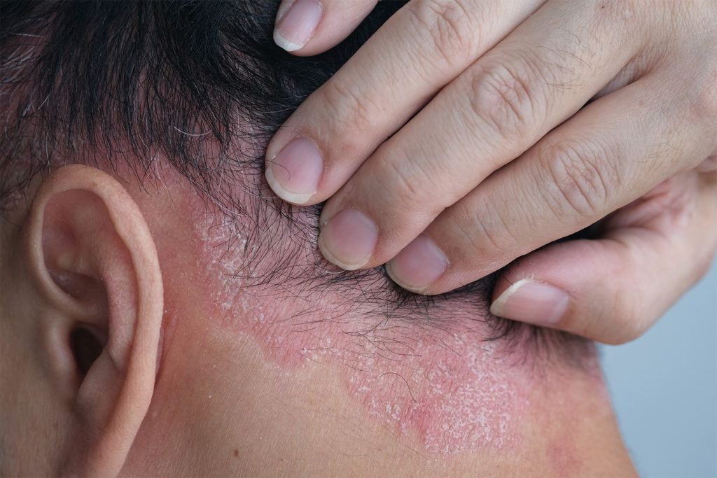 Psoríase em Placas: O Tipo Mais Comum e Seus Tratamentos