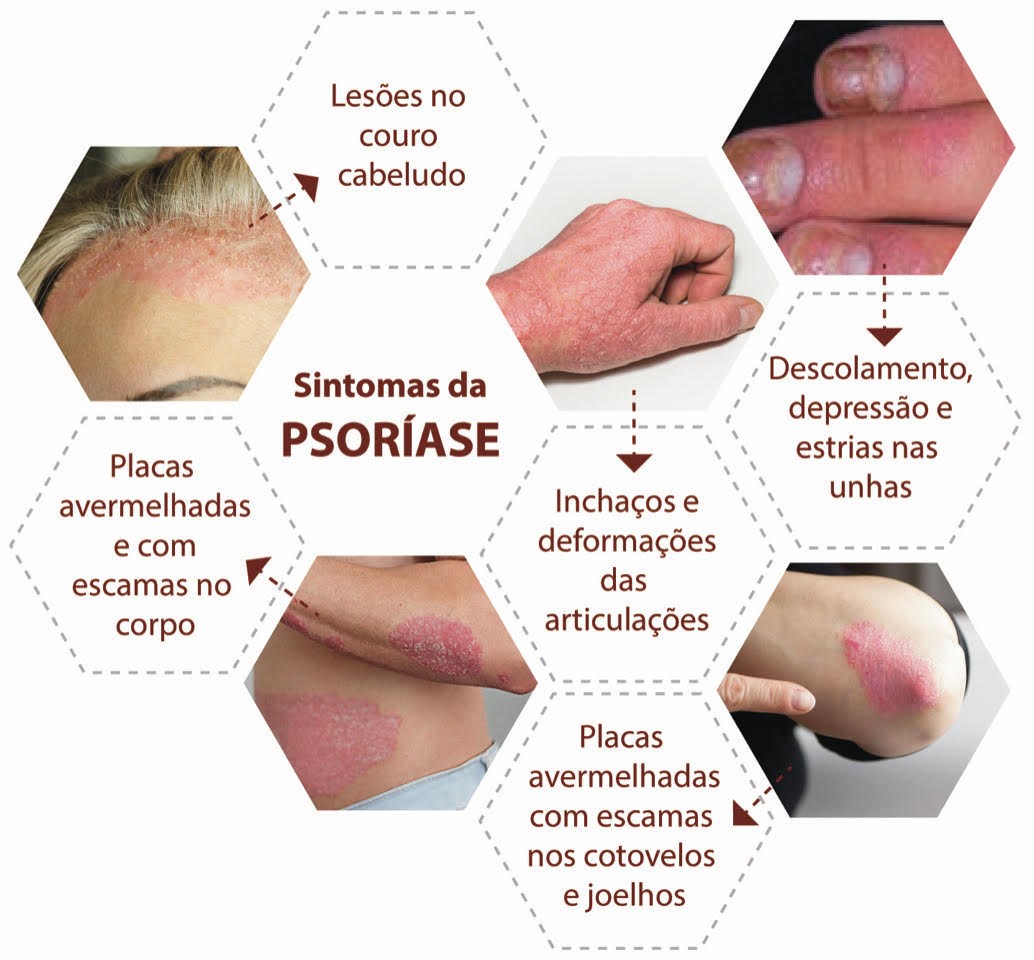 Artrite Psoriásica: Como a Psoríase Afeta as Articulações