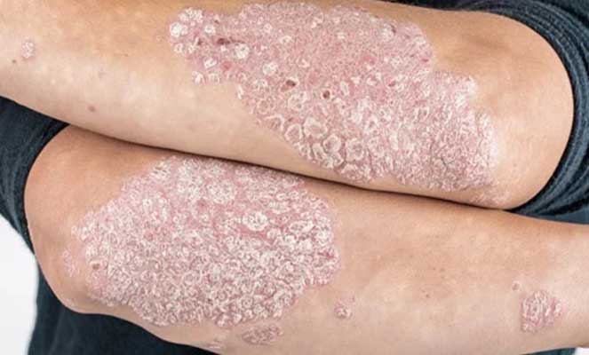 Medicamentos Biológicos para Psoríase: Nomes e Funcionamento