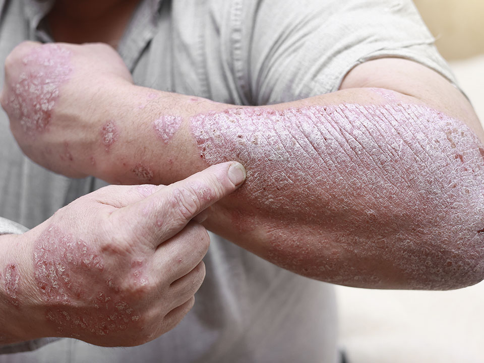 Psoríase no Couro Cabeludo: Sintomas e Cuidados Específicos