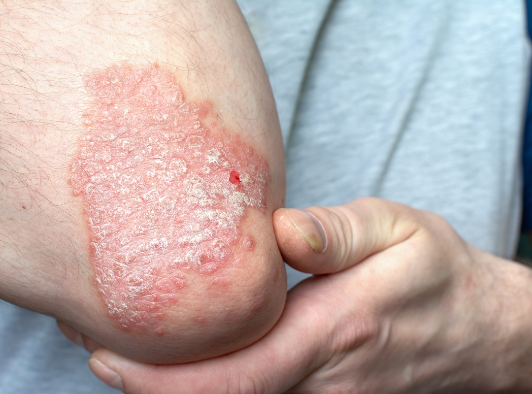 Medicamentos Biológicos para Psoríase: Nomes e Funcionamento