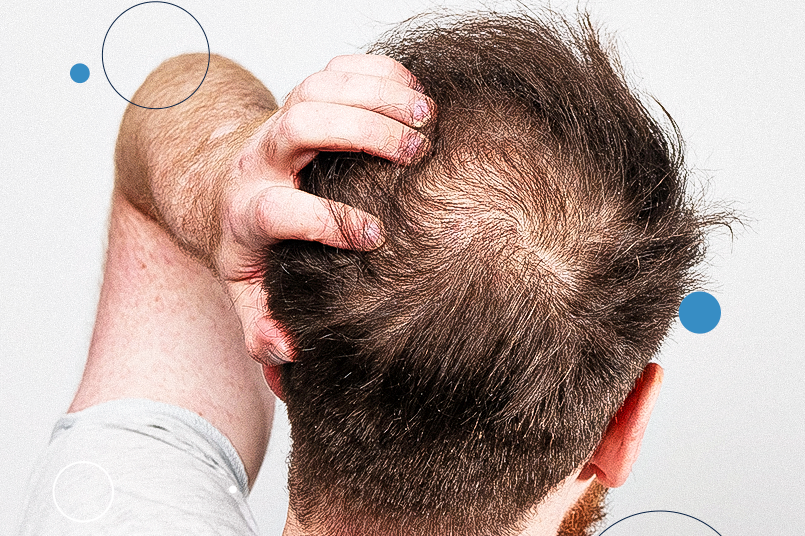 Hipotireoidismo e Queda Capilar: Como a Tireoide Afeta Seus Fios