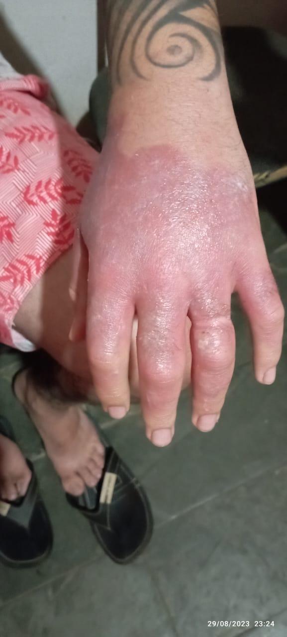 queimadura com limão fotos