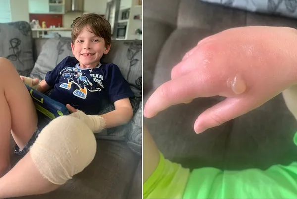 queimadura com limão fotos