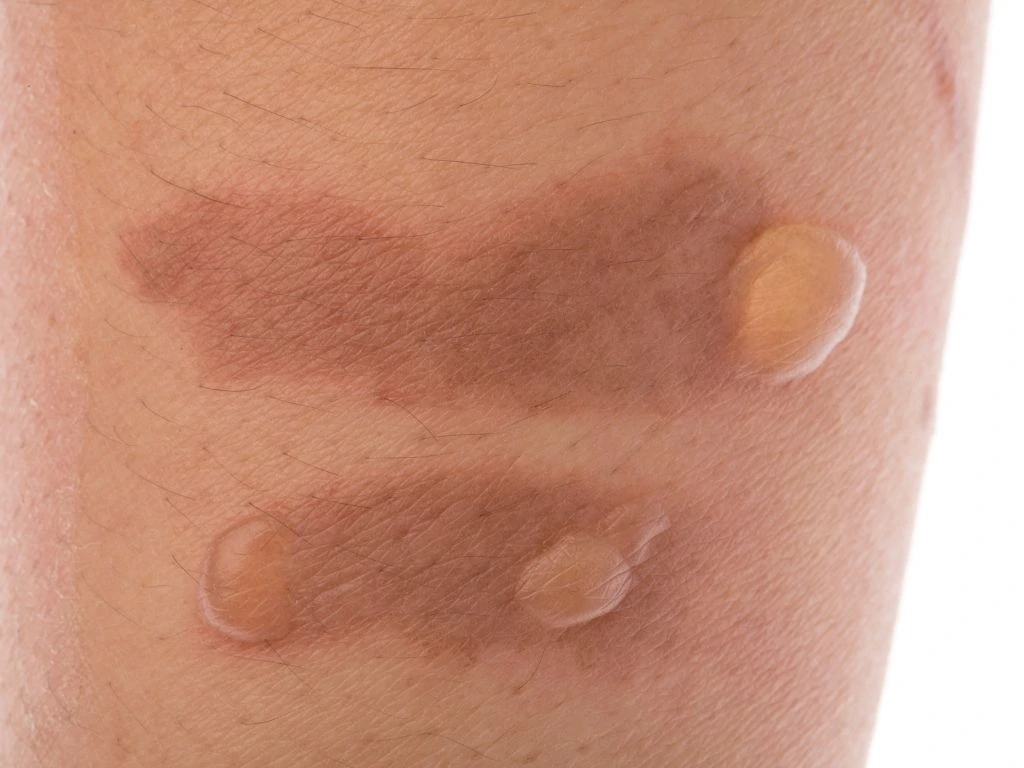 5 ideias de títulos:
1. Fitofotodermatite: O que é e como prevenir a queimadura por limão.
2. Sintomas e tratamentos eficazes para a queimadura de limão.
3. Cuidados essenciais após o contato da pele com limão e sol.
4. Mitos e verdades sobre as manchas de limão na pele.
5. Quando procurar um dermatologista para tratar a fitofotodermatite.