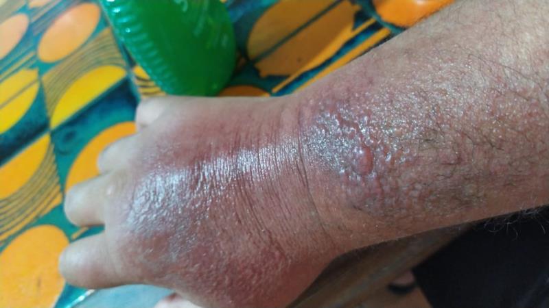 queimadura com limão fotos