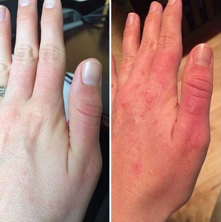 queimadura com limão fotos