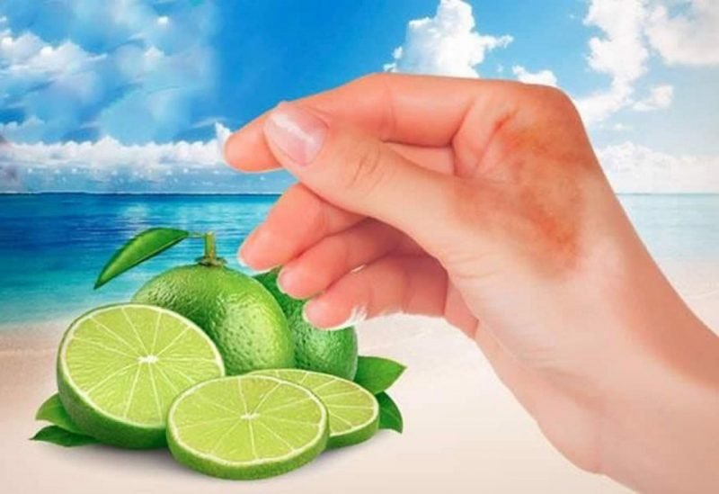 5 ideias de títulos:
1. Fitofotodermatite: O que é e como prevenir a queimadura por limão.
2. Sintomas e tratamentos eficazes para a queimadura de limão.
3. Cuidados essenciais após o contato da pele com limão e sol.
4. Mitos e verdades sobre as manchas de limão na pele.
5. Quando procurar um dermatologista para tratar a fitofotodermatite.