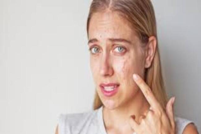 5 ideias de títulos:
1. Fitofotodermatite: O que é e como prevenir a queimadura por limão.
2. Sintomas e tratamentos eficazes para a queimadura de limão.
3. Cuidados essenciais após o contato da pele com limão e sol.
4. Mitos e verdades sobre as manchas de limão na pele.
5. Quando procurar um dermatologista para tratar a fitofotodermatite.