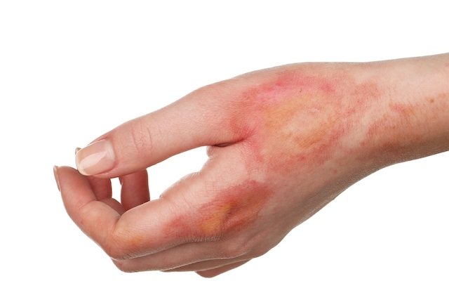 5 ideias de títulos:
1. Fitofotodermatite: O que é e como prevenir a queimadura por limão.
2. Sintomas e tratamentos eficazes para a queimadura de limão.
3. Cuidados essenciais após o contato da pele com limão e sol.
4. Mitos e verdades sobre as manchas de limão na pele.
5. Quando procurar um dermatologista para tratar a fitofotodermatite.