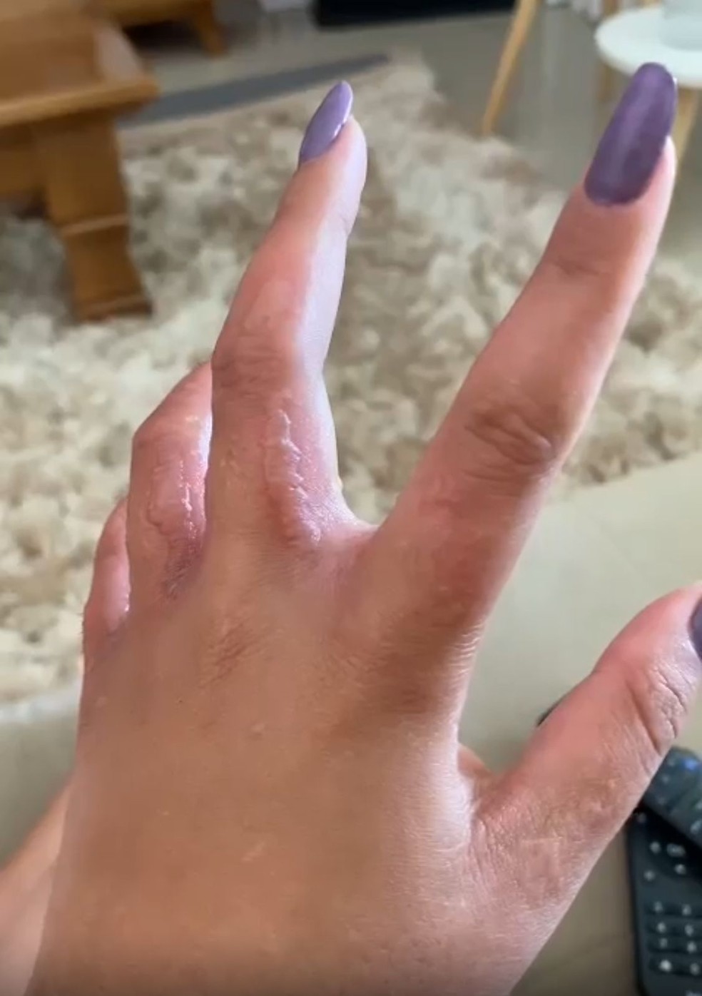 queimadura com limão fotos